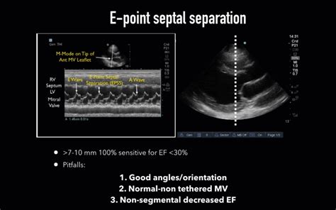 lv function echo cardiology